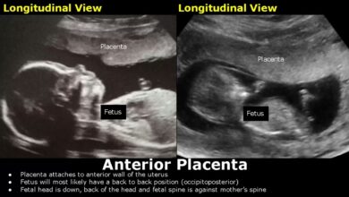 एंटीरियर प्लेसेंटा क्या होता है