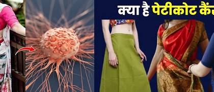 पेटीकोट कैंसर