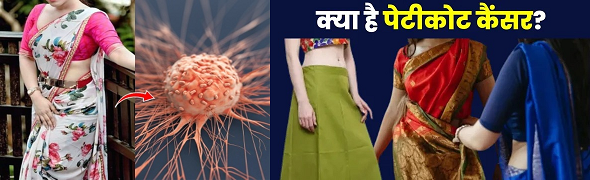 पेटीकोट कैंसर